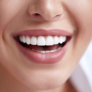 dental bleaching6