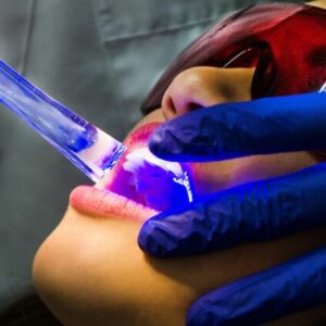 dental bleaching7