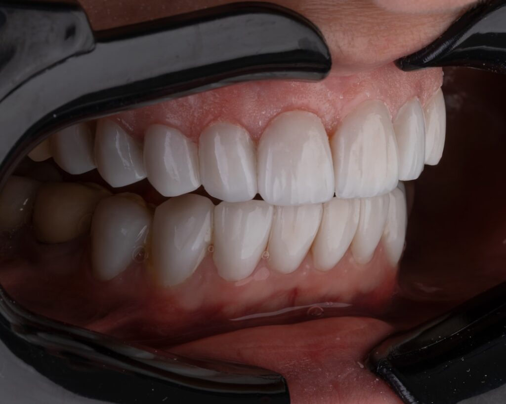 Photo Decayed tooth