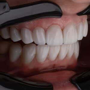 Photo Decayed tooth