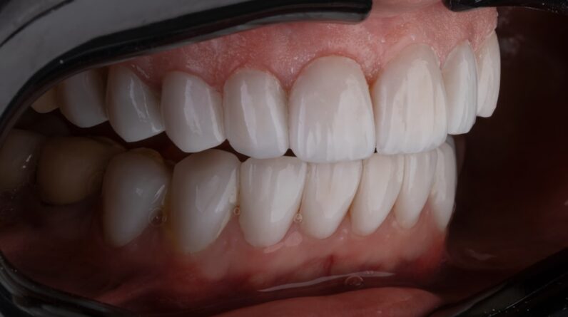 Photo Decayed tooth