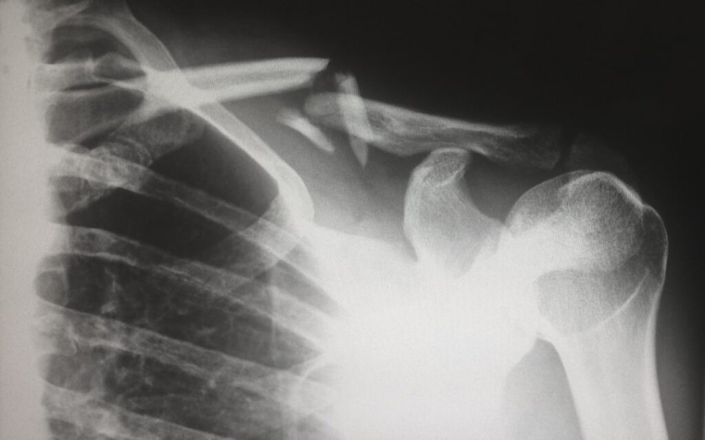 Photo Tooth X-ray
