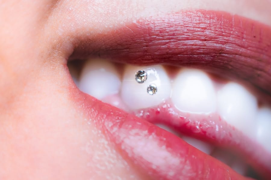 Photo "The Benefits of Invisalign over Traditional Braces"