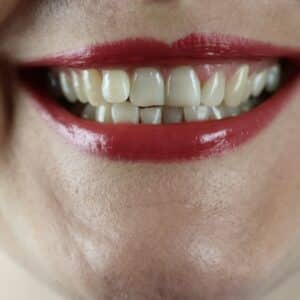 Photo "Are There Any Additional Out-of-pocket Costs for Cosmetic Dental Procedures Under Medicare?"