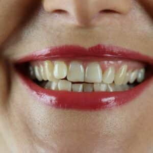 Photo "Are There Any Age Restrictions for Receiving Cosmetic Dental Care Under Medicare?"