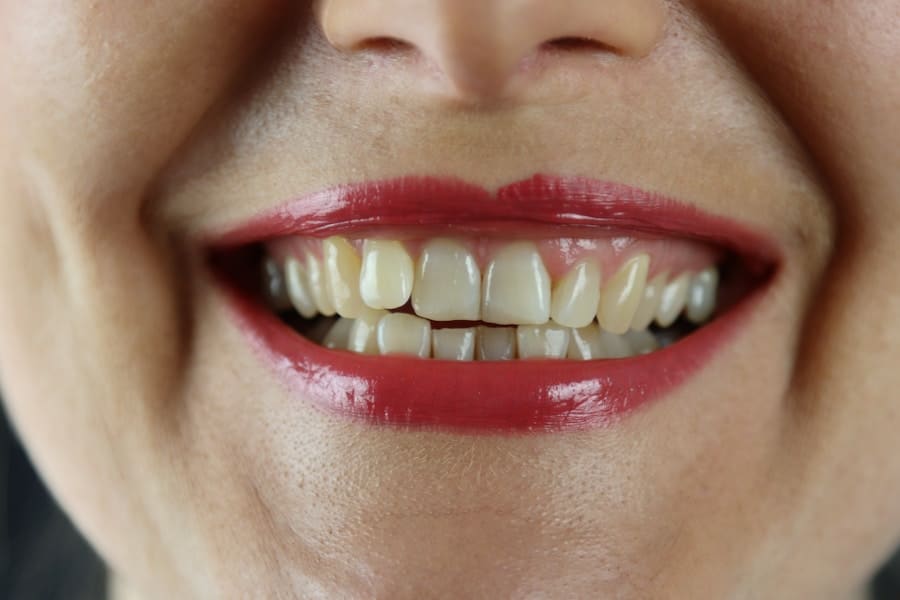 Photo "Are There Any Age Restrictions for Receiving Cosmetic Dental Care Under Medicare?"