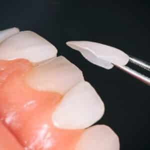 Photo "Can Medicare Cover the Cost of Dental Crowns or Bridges for Cosmetic Purposes?"