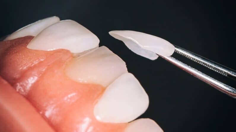 Photo "Can Medicare Cover the Cost of Dental Crowns or Bridges for Cosmetic Purposes?"