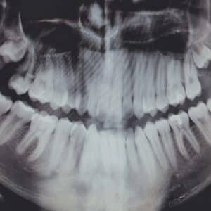 Photo "Does Medicare Cover Cosmetic Dental Procedures for Reconstructive Purposes After an Accident?"