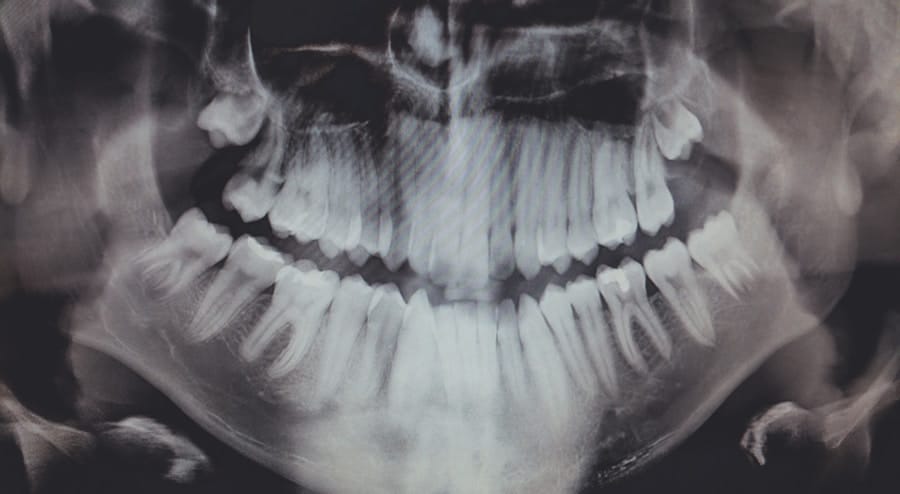 Photo "Does Medicare Cover Cosmetic Dental Procedures for Reconstructive Purposes After an Accident?"