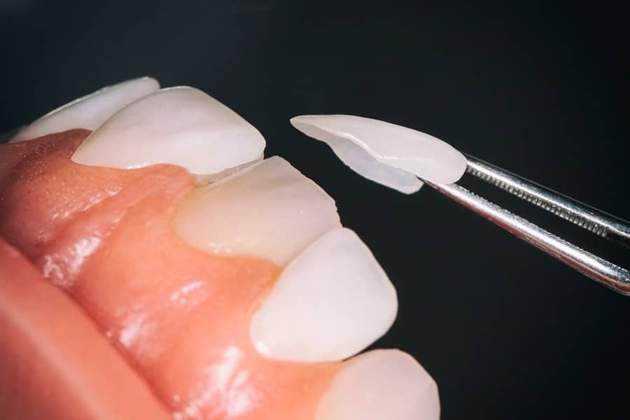 Photo "Are Preventative Cosmetic Dental Treatments, Such As Sealants, Covered by Medicare?"