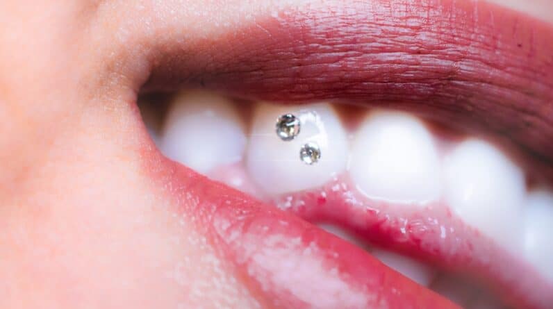 Photo Dental Bridges