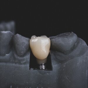 Photo Dental Implants