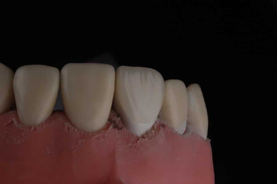 Chipped Tooth Repair