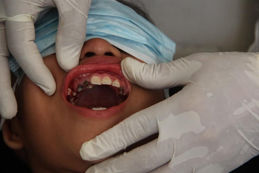 Cracked Tooth Repair Frisco Tx 2 Cracked Tooth Repair