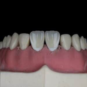Photo Teeth Straightening