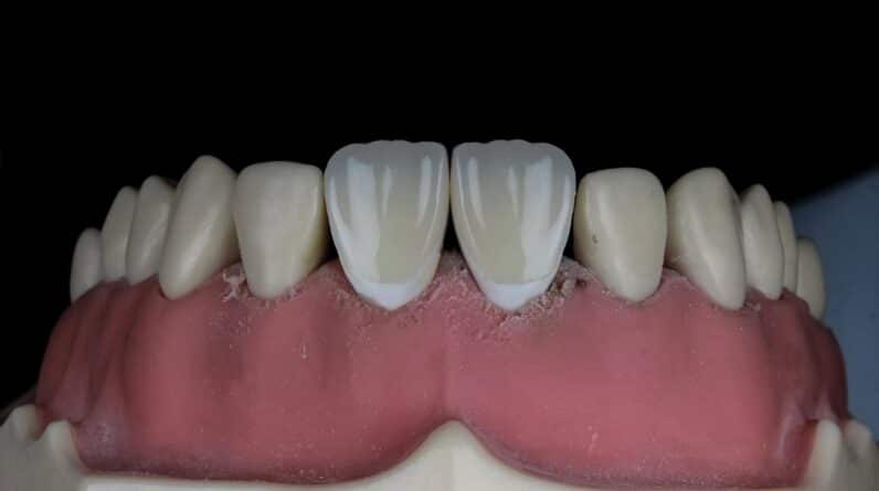 Photo Teeth Straightening