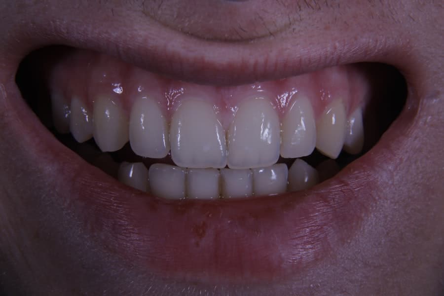 Photo Teeth Straightening