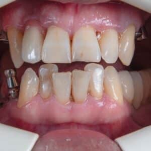 Photo Teeth Whitening Chandler Az