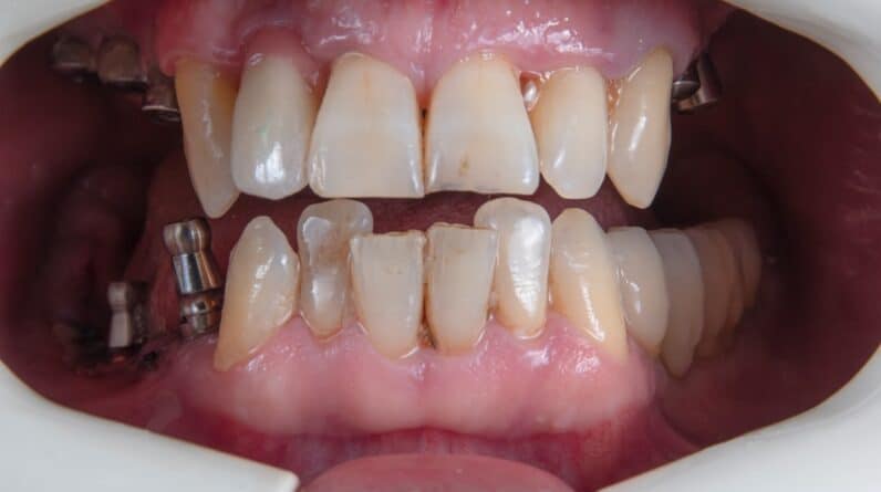 Photo Teeth Whitening Chandler Az