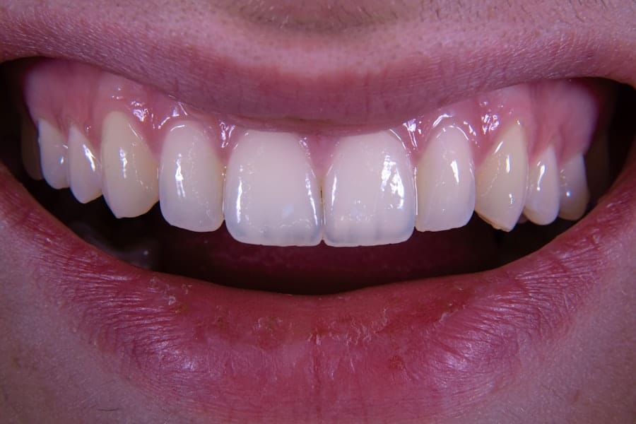 Teeth Whitening Chandler Az 3 Photo Teeth Whitening Chandler Az