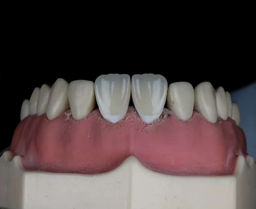 Photo Veneers
