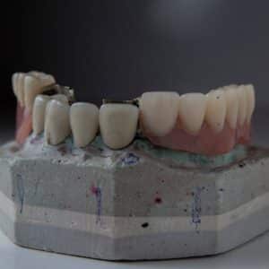 Photo Dental Fillings