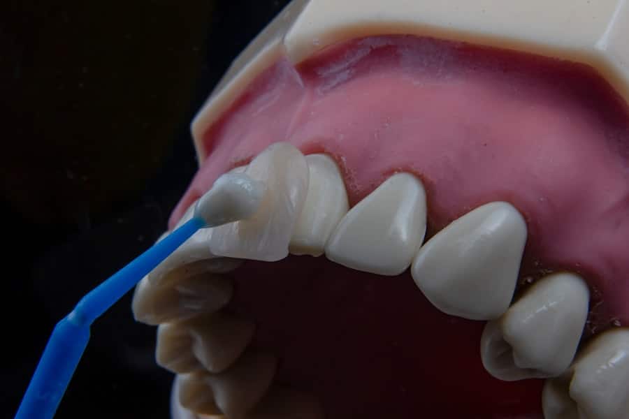 Photo Dental Fillings