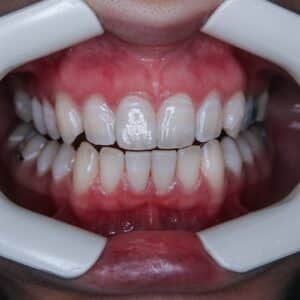 Photo Dental Bonding