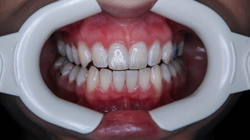 Photo Dental Bonding