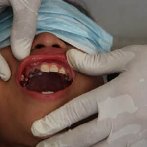 Photo Cracked Tooth Repair