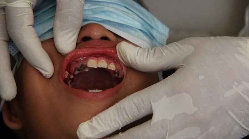 Photo Cracked Tooth Repair