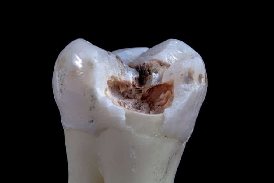 Photo Cracked Tooth Repair