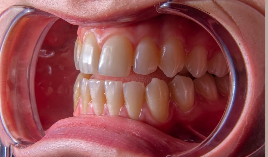 Photo Cavity Prevention