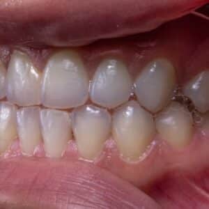 Photo Teeth Straightening Chandler Az