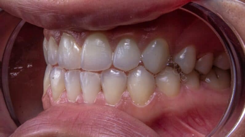 Photo Teeth Straightening Chandler Az