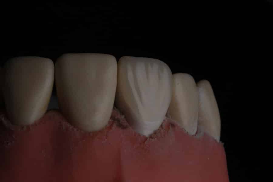 Photo Teeth Straightening Chandler Az