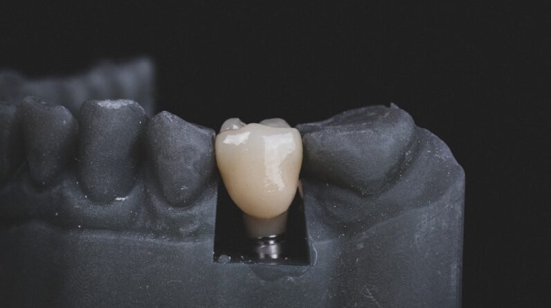 Photo Dental Implant Cost