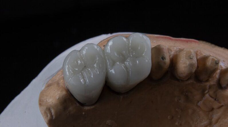 Photo Dental Implants