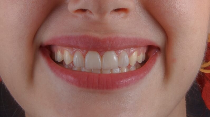 Photo Teeth Whitening