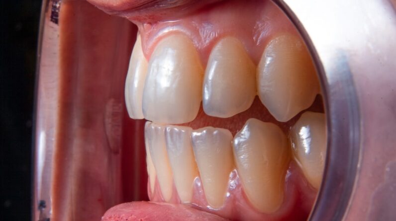 Photo Dental Implant Recovery Tips