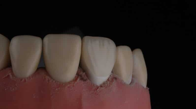 Photo Cracked Tooth Repair