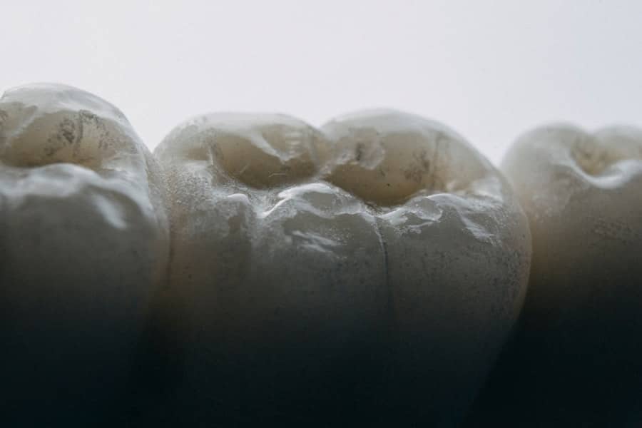 Cracked Tooth Repair Frisco Tx 3 Photo Cracked Tooth Repair